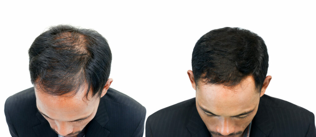 before and after bald head of a man on white background.