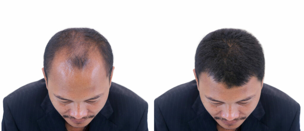 before and after bald head of a man .